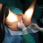 Realizando extracci&oacute;n fase lipotransfer